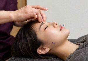 美容はり施術